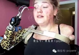 断臂女孩视频,逆境中的生命奇迹